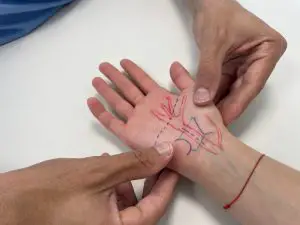 ¿Qué pasa si te cortas un nervio de la mano?